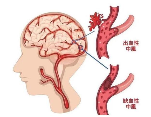 夏季老人中风如何护理？细心护理，可帮助老人尽快康复