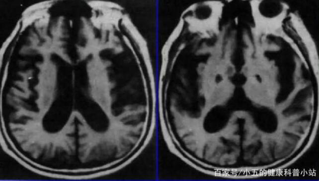 注意老年痴呆早期信号，科学服用5种药物，同时积极做好日常防范